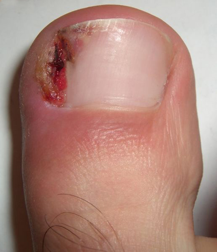 Get Ingrown toenails treated right away